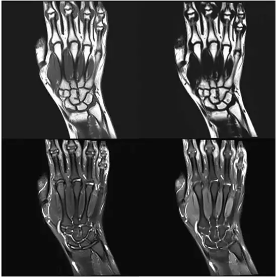 MRI Screening Of Hand